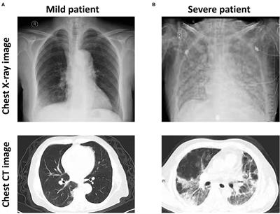 Abnormal Coagulation Function of Patients With COVID-19 Is Significantly Related to Hypocalcemia and <mark class="highlighted">Severe Inflammation</mark>